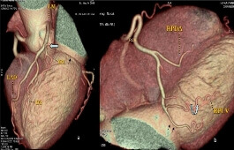 Heart demonstrating absent left circumflex artery 