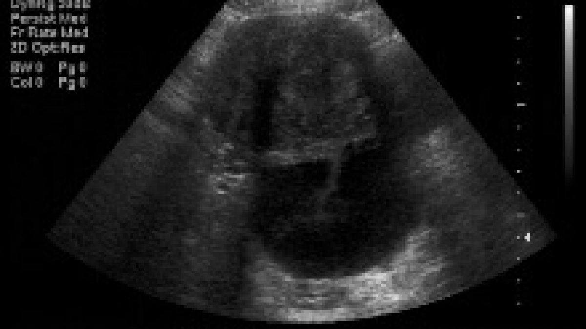 pelvic inflammatory disease ultrasound