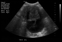 Transabdominal ultrasound scan.