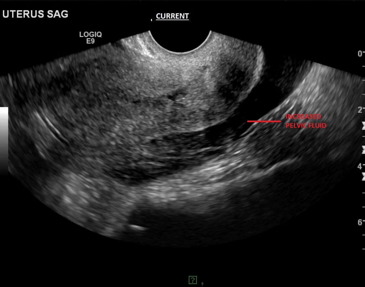 Ruptured Ectopic Pregnancy Ultrasound