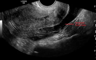 Radiology Case of the month: Right Adnexal Ectopic Gestation