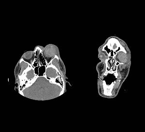 Traumatic globe Injury