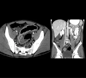 Left renal infarct