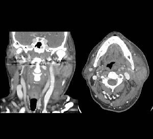 Acute parotitis with deep neck space infection