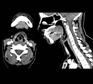 Thyroglossal duct cyst