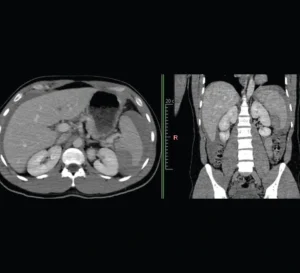 CT images of the abdomen