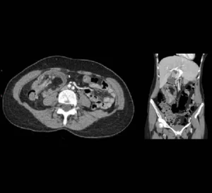 Acute colo-colic intussusception