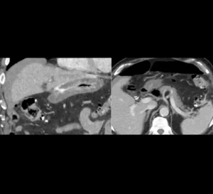 Gastric perforation