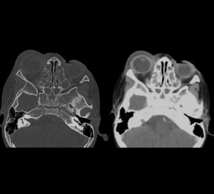 peri orbital cellulitis