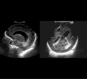 Germinal Matrix Hemorrhage