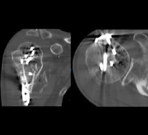 Emphysematous osteomyelitis