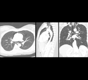 Pneumomediastinum