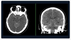 Comatose patient following a hypoxic event